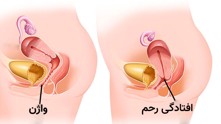 افتادگی رحم یا پروپلاس (Uterine Prolapse) چیست؟