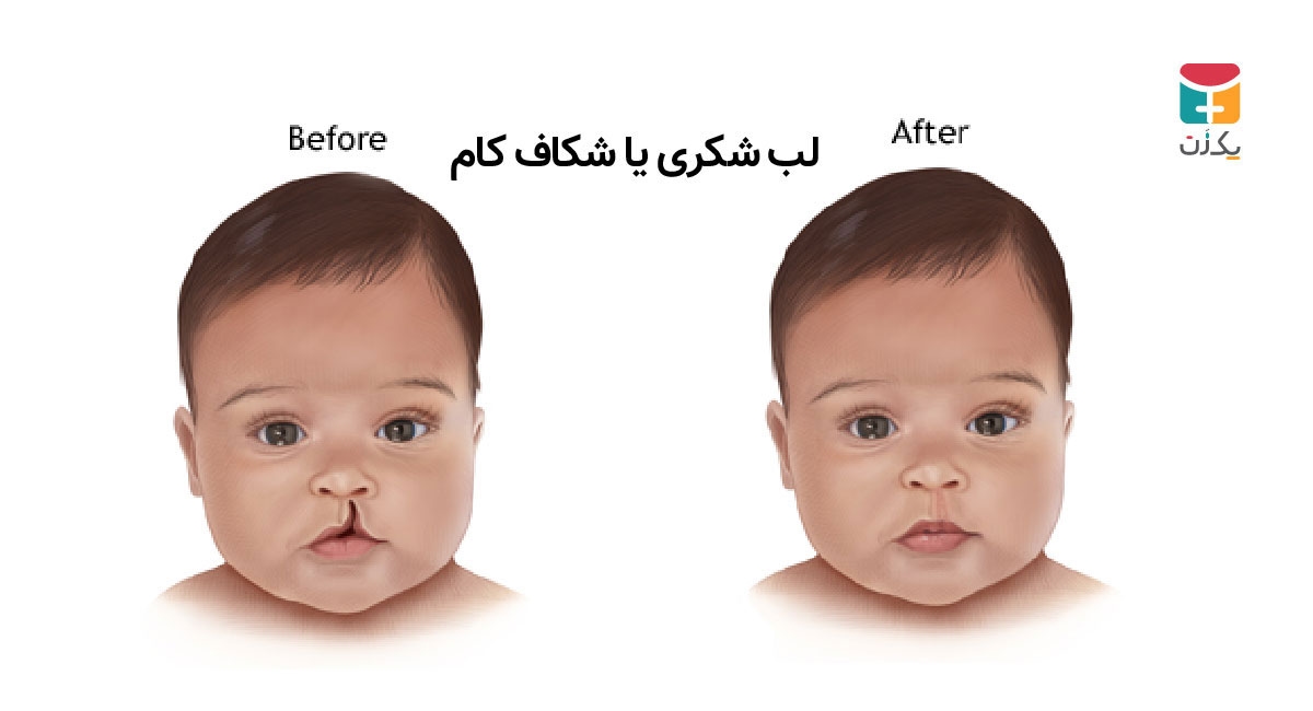 لب شکری یا شکاف کام