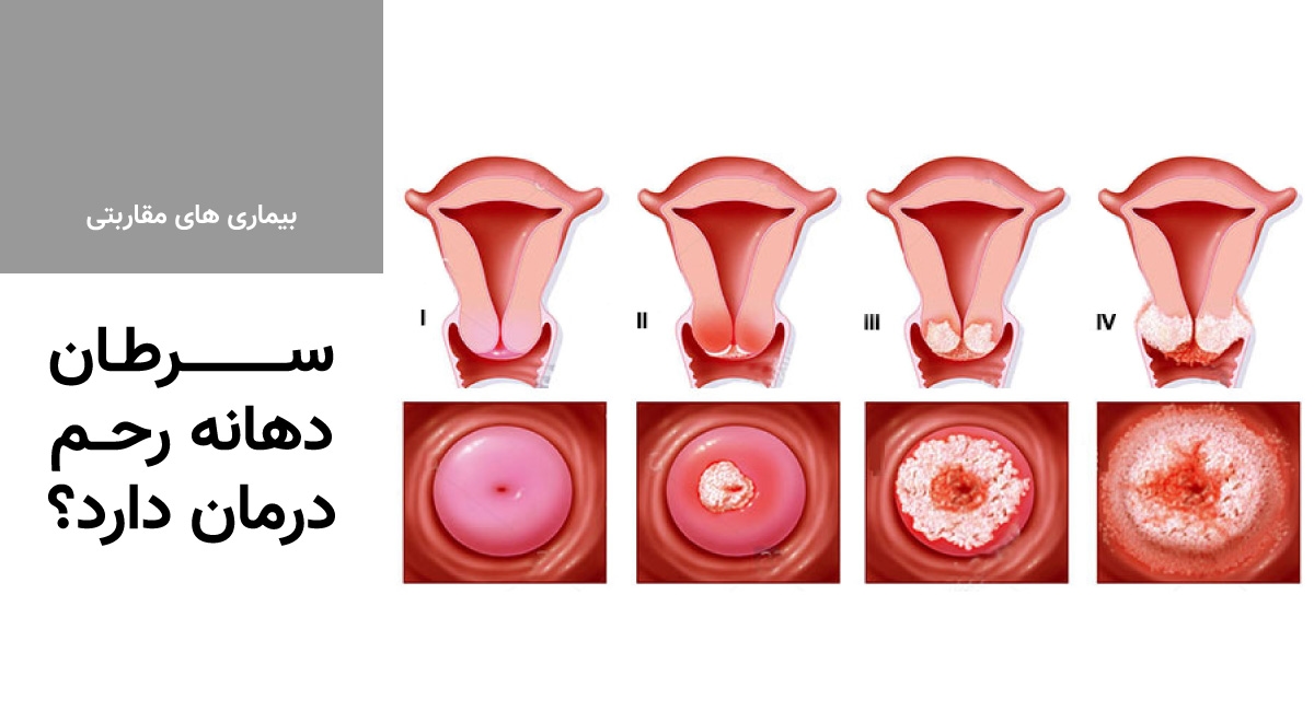 سرطان دهانه رحم درمان دارد؟