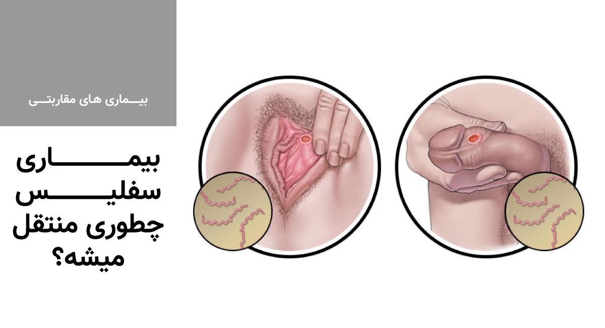 بیماری سفلیس چگونه منتقل می شود؟