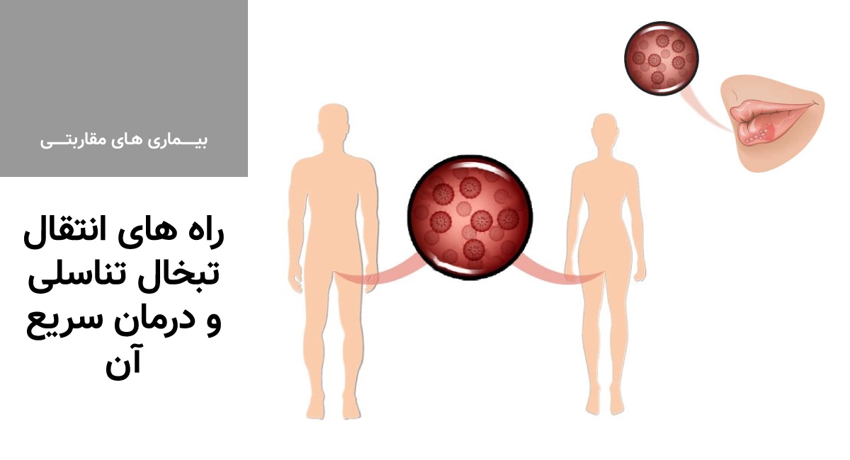 راه های انتقال تبخال تناسلی و درمان سریع آن