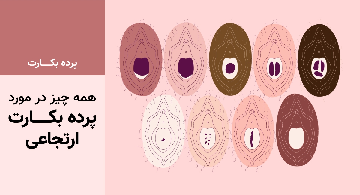 همه چیز در مورد پرده بکارت ارتجاعی 
