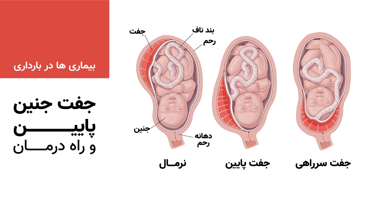 جفت جنین پایین و راه درمان