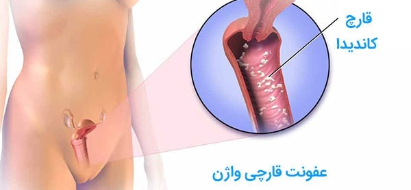 درباره عفونت قارچی واژن و درمان آن چه می دانید؟