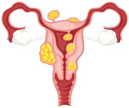 فیبروم چیست و چه علائمی دارد؟