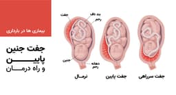 جفت جنین پایین و راه درمان