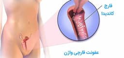 درباره عفونت قارچی واژن و درمان آن چه می دانید؟